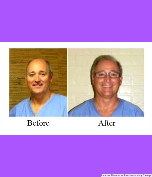  Patient Hair Transplant Cost is $2,400.00